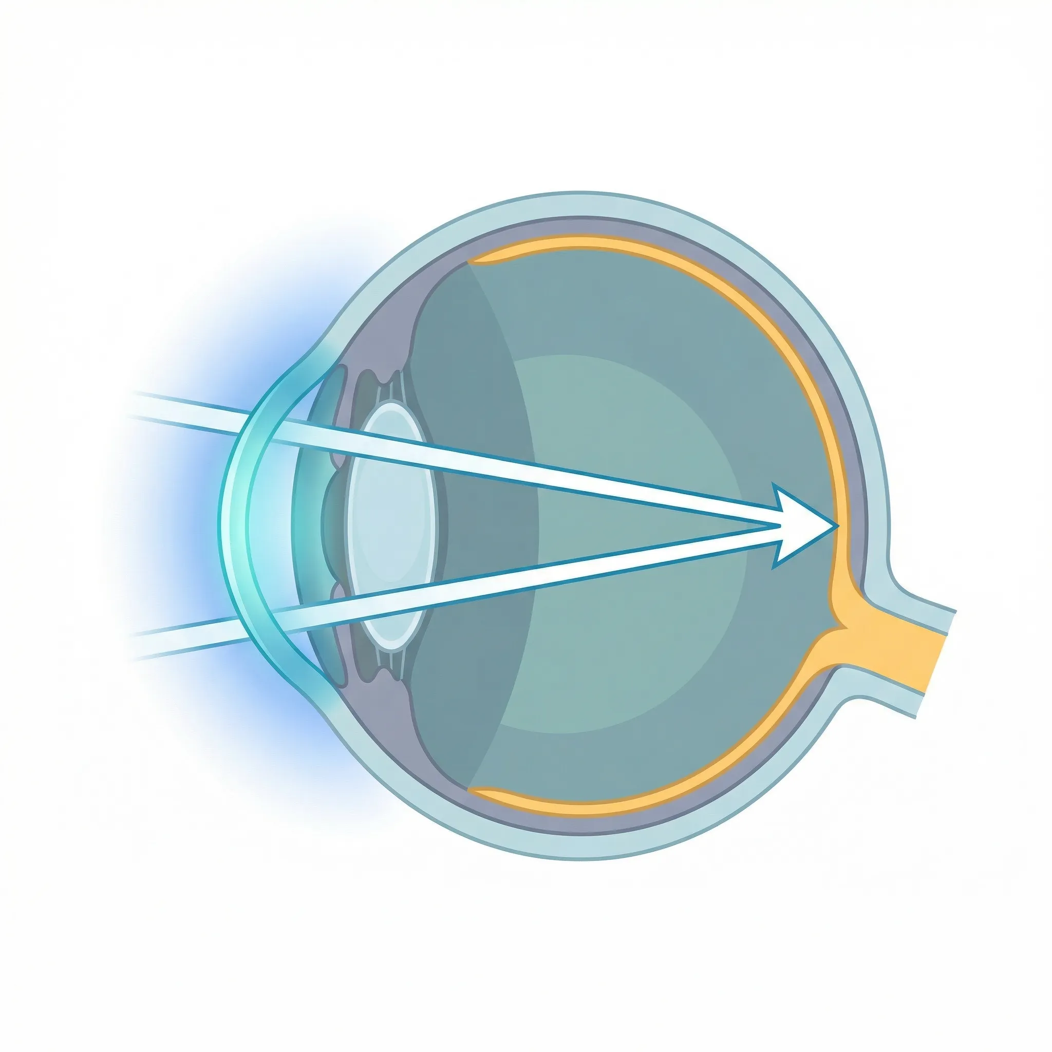 Reshaped cornea — light focuses directly on retina for clear vision